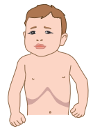 signes de la brconchiolite