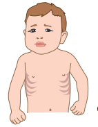 signes de la brconchiolite