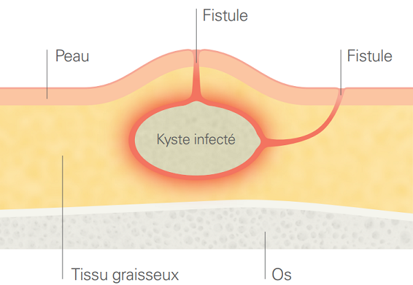 kyste infecté