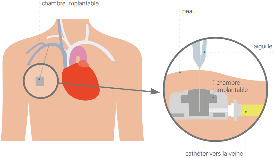 dispositif d’accès veineux implantable - DAVI