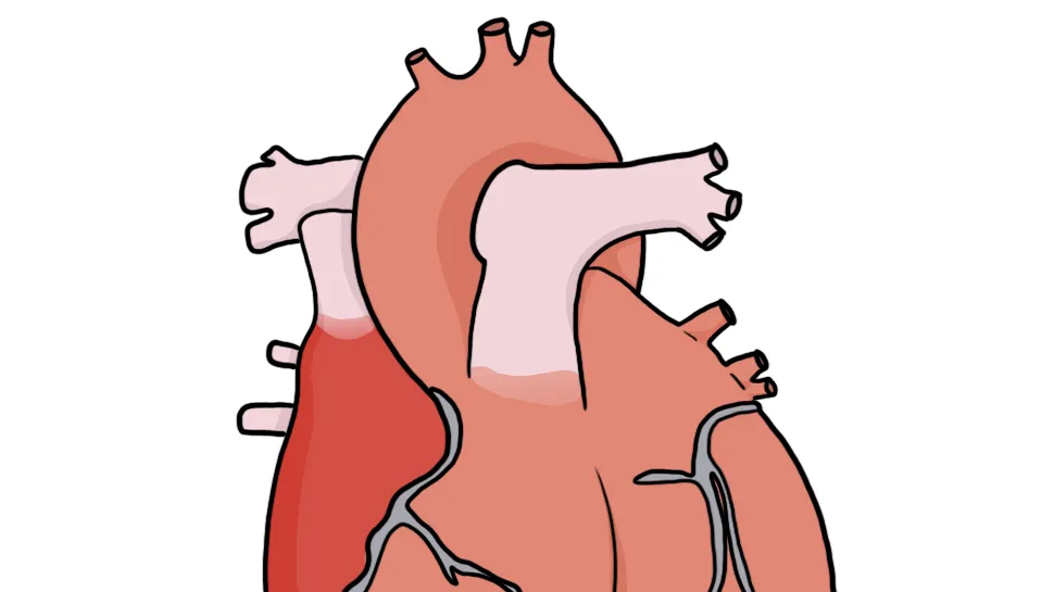 Coeur