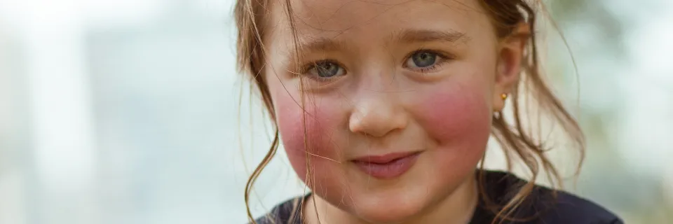 fille joues rouges allergie