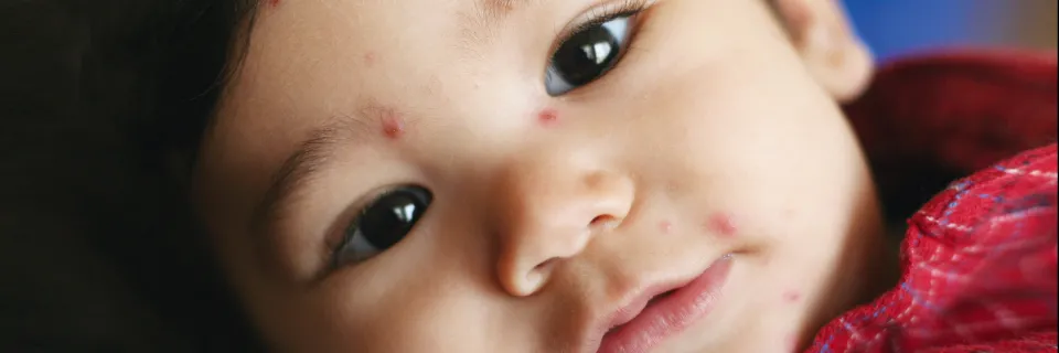 Varicelle - infectiologie pédiatrique