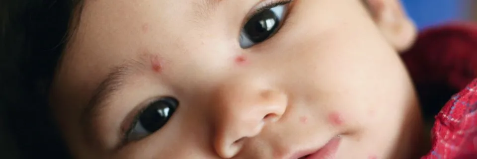 Vaccination contre la varicelle